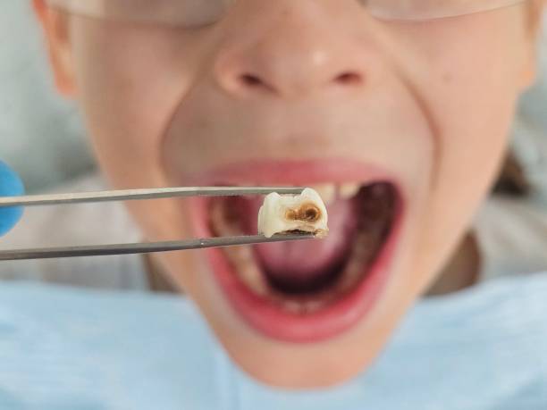Best Broken or Chipped Tooth Repair in Kechi, KS